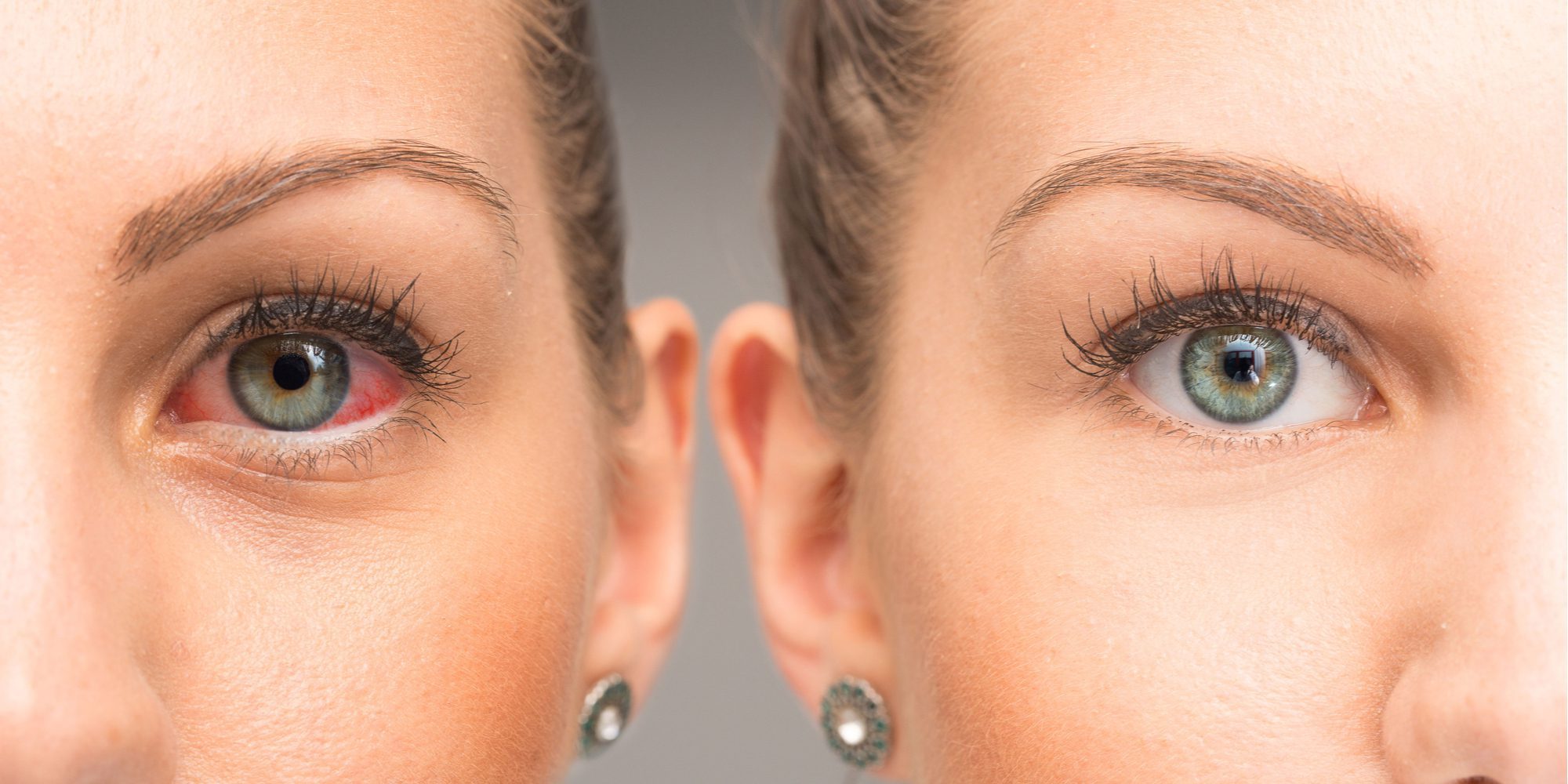 7 Habits That Cause Under Eye Puffiness And How to Fix It