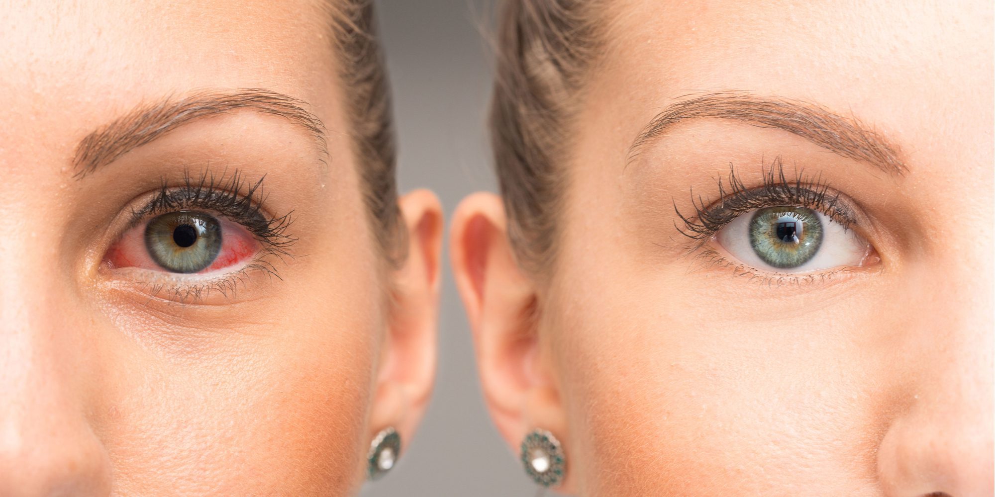 Alcoholic Eyes Symptoms Outlook And Treatment Blackberry Center